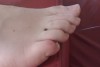 Blistered little toe from summit sock stitching
