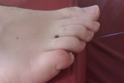Blistered little toe from summit sock stitching