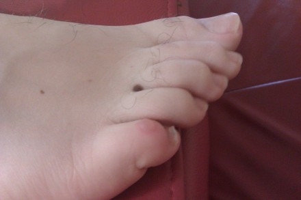 Blistered little toe from summit sock stitching